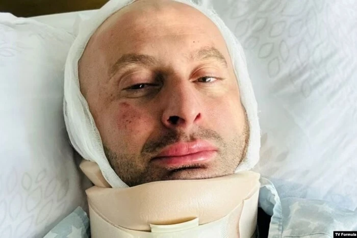 Journalist with facial bone fractures